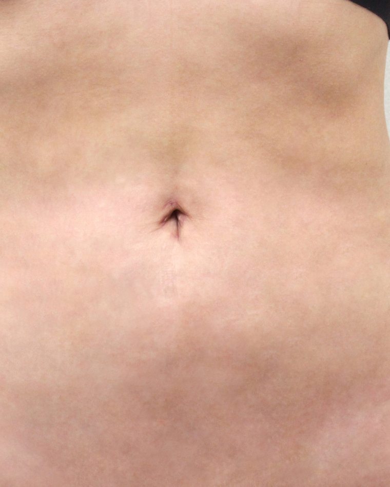 Liposuction — after treatment